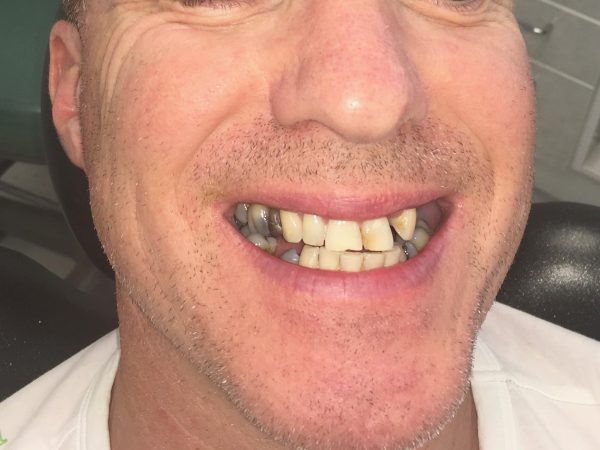 crooked smile before crowns