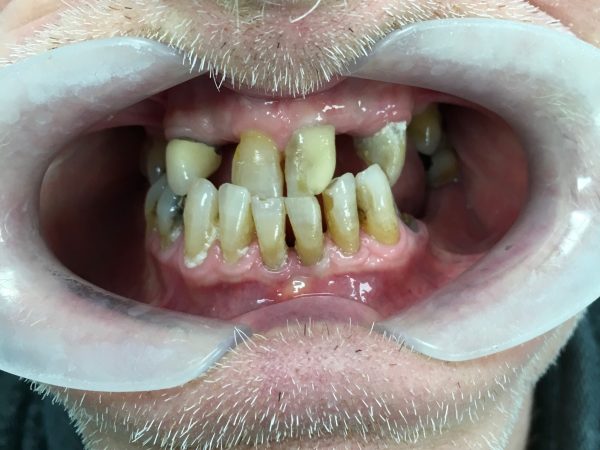 upper full implant lower crown before