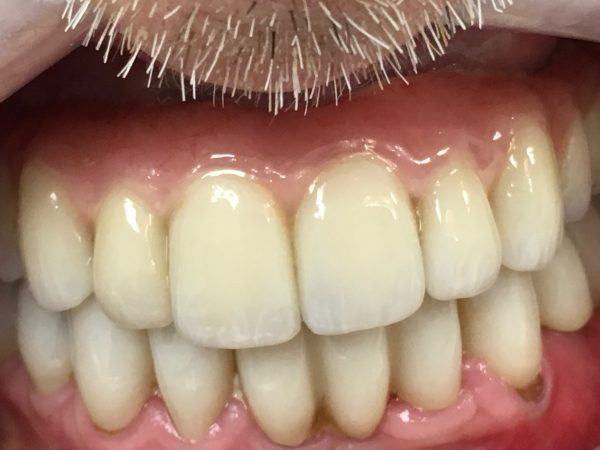 upper full implant lower crown after