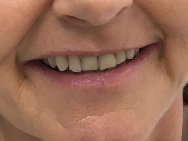 misshaped teeth before veneers