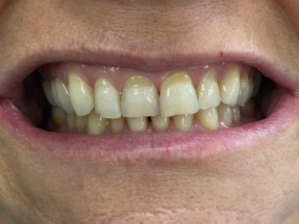 tooth decay before veneers