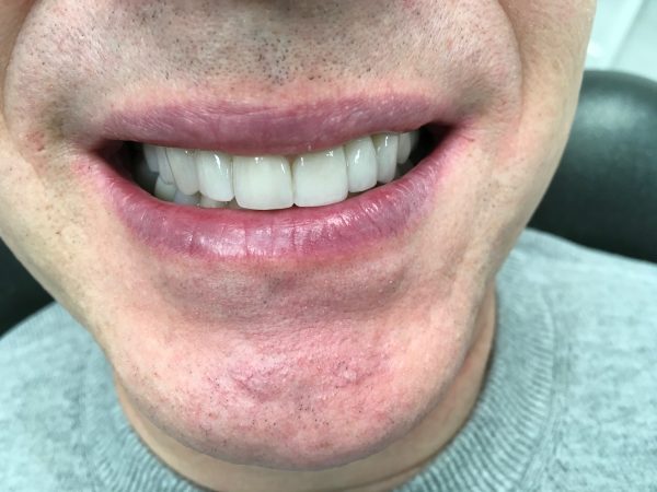 crooked smile after crowns