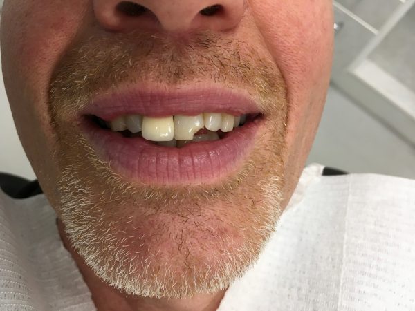 chipped teeth before crowns