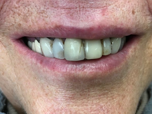 discolored teeth before crowns