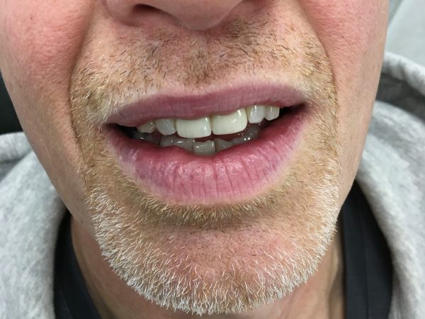 fix chipped teeth with crowns