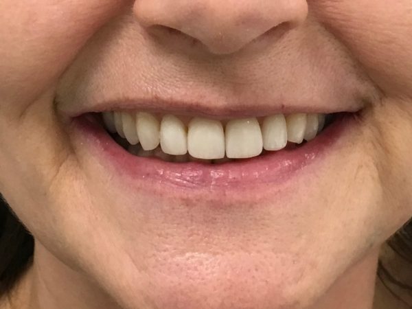 misshaped teeth after veneers