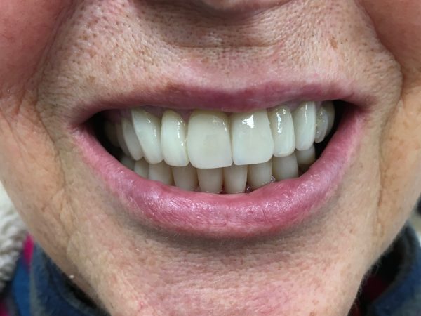 discolored teeth after crowns