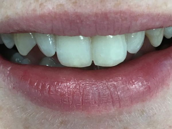 composite bonding before