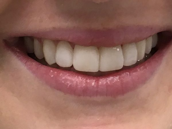 why choose composite bonding