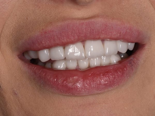 zoom teeth whitening lymington