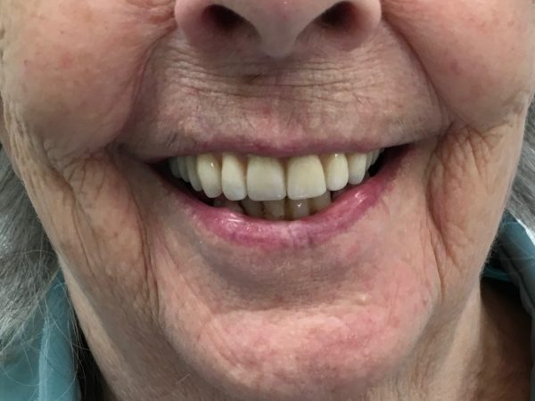 before and after dental implants