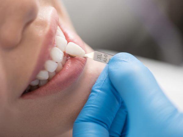 dental crowns holbury