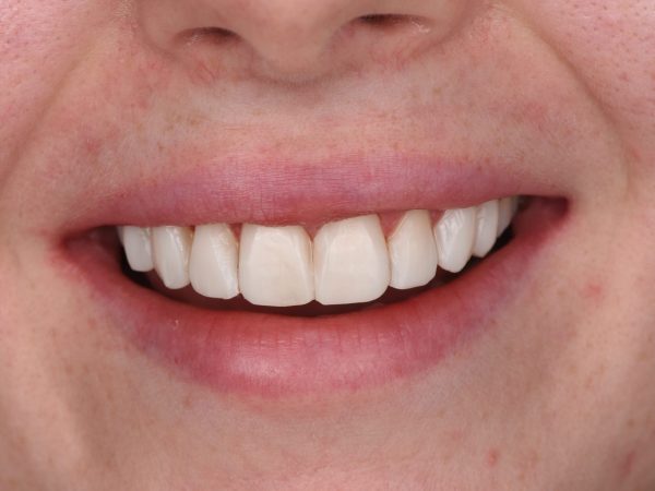 composite bonding holbury