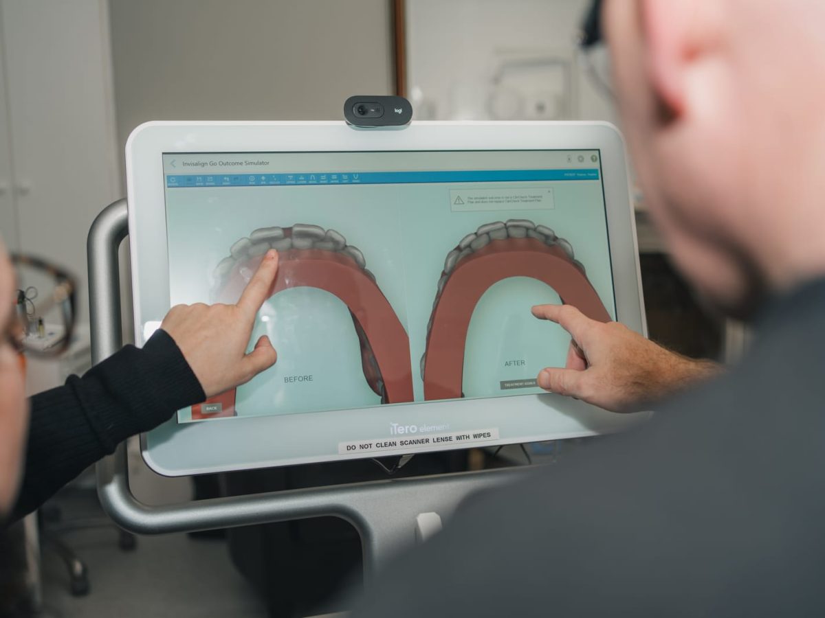 Invisalign smile preview